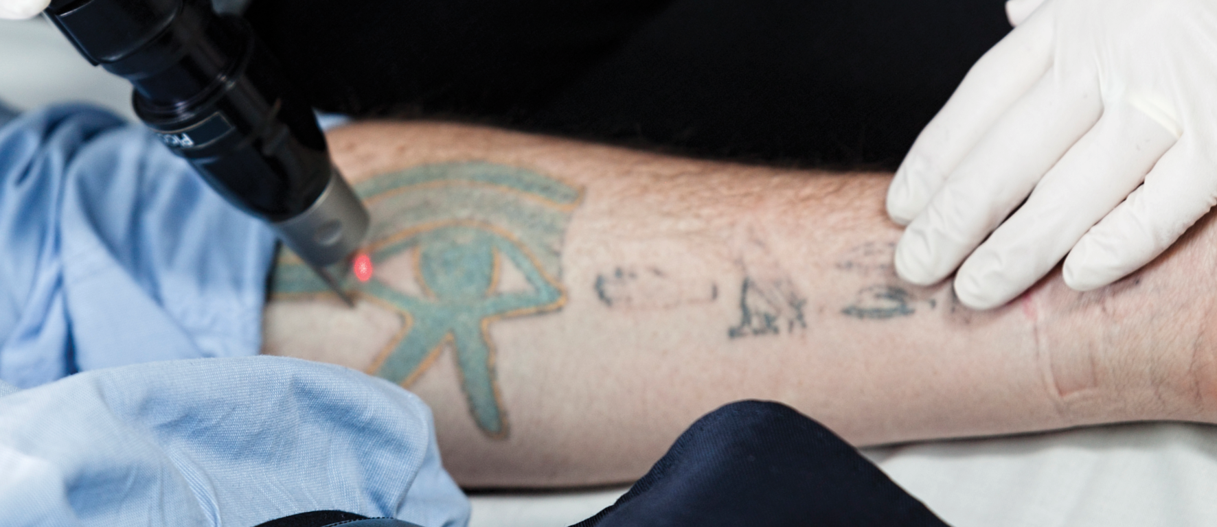 Tattoo Removal for Sensitive Areas: What You Need to Know | AllWhite Laser  | AW3®
