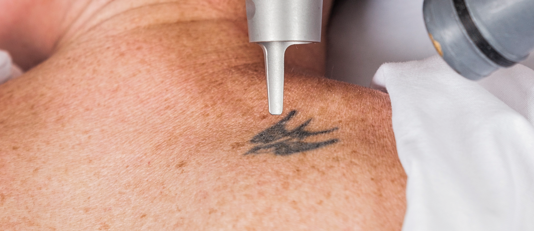 Permanent Laser Tattoo Removal in Bangalore | Nyraa