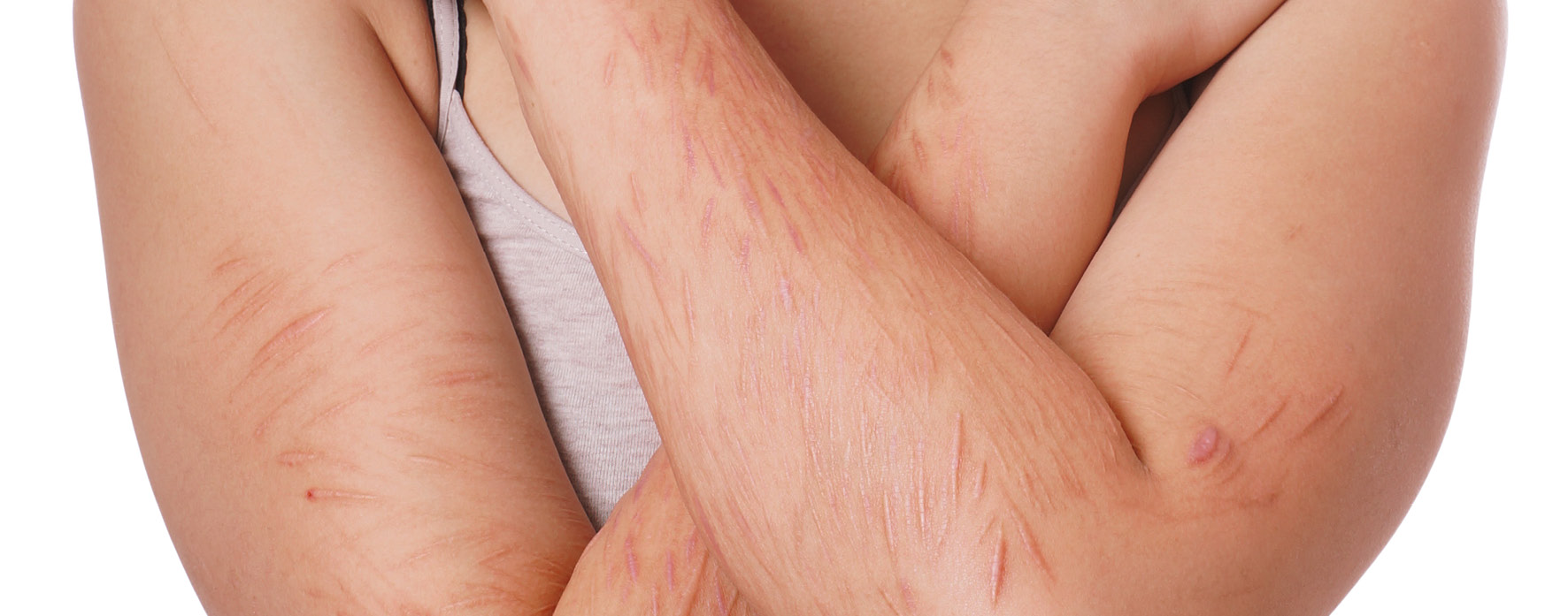 Treating self harm scars - you don't have to live with those scars